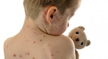 O sarampo é uma doença altamente contagiosa transmitida pela fala, tosse e espirro