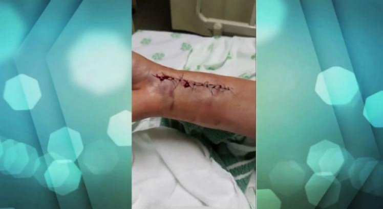 Vítima sofreu uma fratura no pulso esquerdo