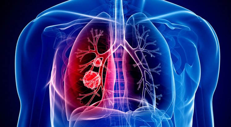 Pneumologista explica a importância de seguir o tratamento da Tuberculose