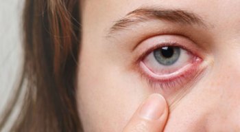 O contato dos olhos componentes tóxicos pode provocar conjuntivite, ardência, irritação, entre outros problemas