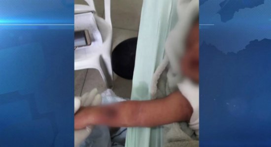 Bebê de 17 dias corre risco de perder braço por causa de medicação