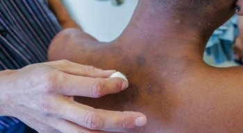 A hanseníase é uma doença infecciosa crônica, causada por uma bactéria, que atinge principalmente a pele e os nervos periféricos