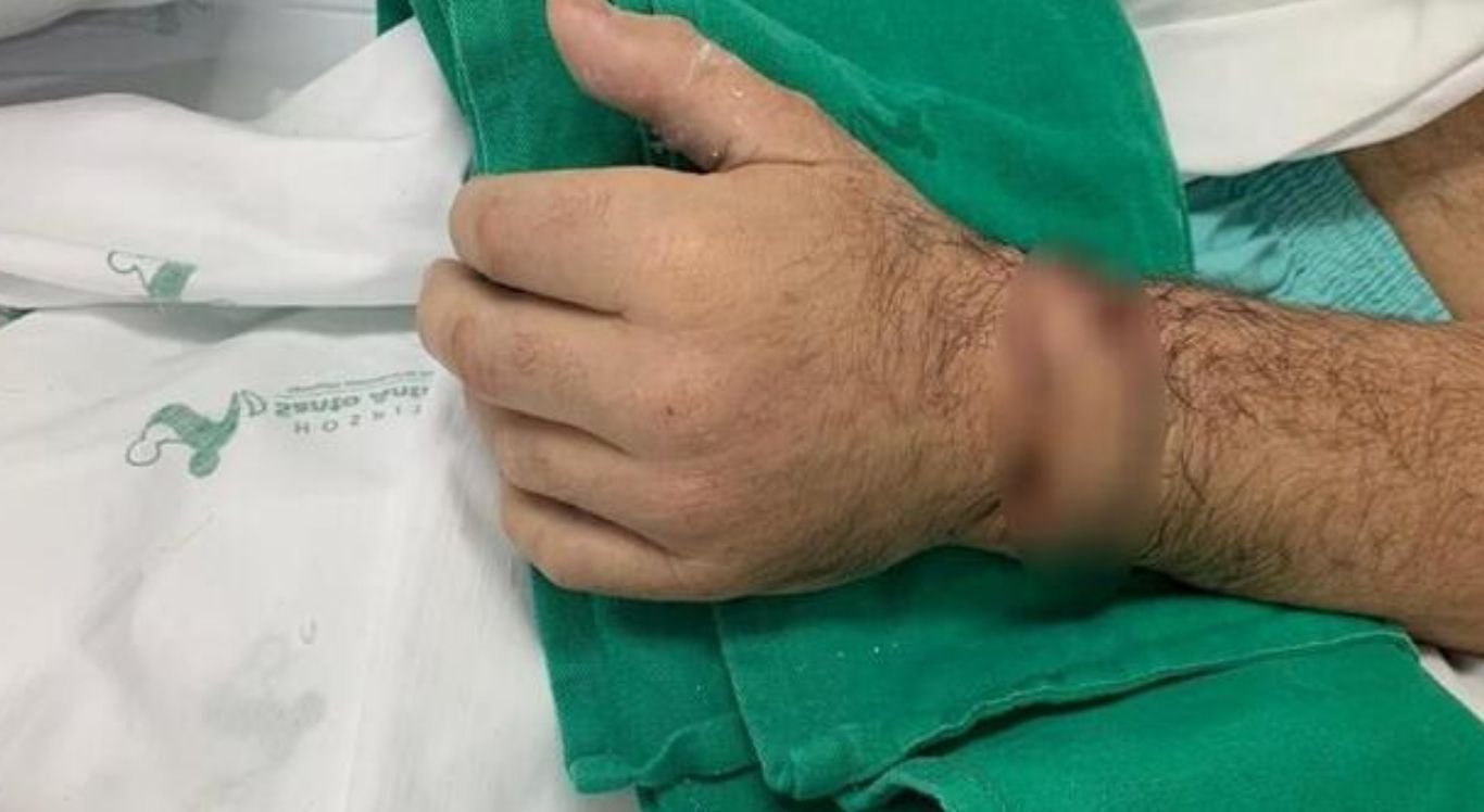 O paciente contou a equipe médica que, durante uma briga, conseguiu pegar a mão do chão, mesmo ensanguentado, e a armazenou numa sacola com gelo