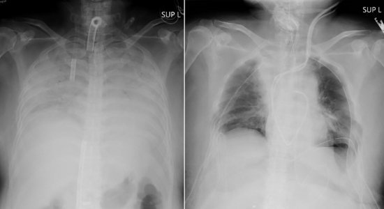 Este foi o 1º transplante mundial de tecido pulmonar de doadores vivos para um paciente com grave lesão pulmonar causada pela Covid-19.