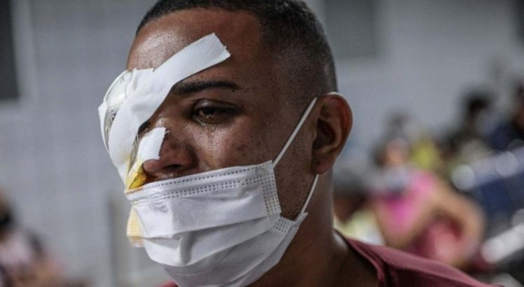 Jovem baleado no olho por PMs em protesto no Recife recebe alta, mas perda de visão é irreversível