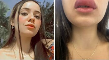 Nataly Galdino, de 21 anos, precisou ser levada às pressas para uma unidade de saúde após ser picada por lacraia