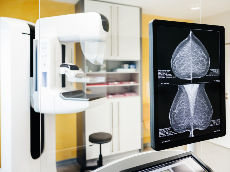 Equipamento de mamografia branco em um consultório, com um monitor à direita exibindo imagens de radiografia mamária (mamografia) em preto e branco.
