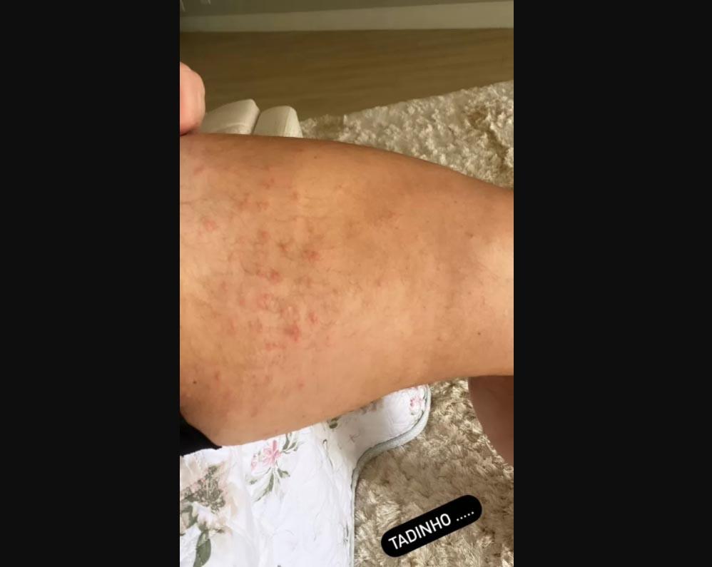 Esposa de Leonardo mostra a situação da perna dele após ter sarna - Crédito: Reprodução / Instagram