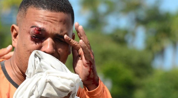 Jonas Correia de Fran&ccedil;a, v&iacute;tima de bala de borracha disparada pela pol&iacute;cia durante protesto no Recife. Ele nao participava do protesto