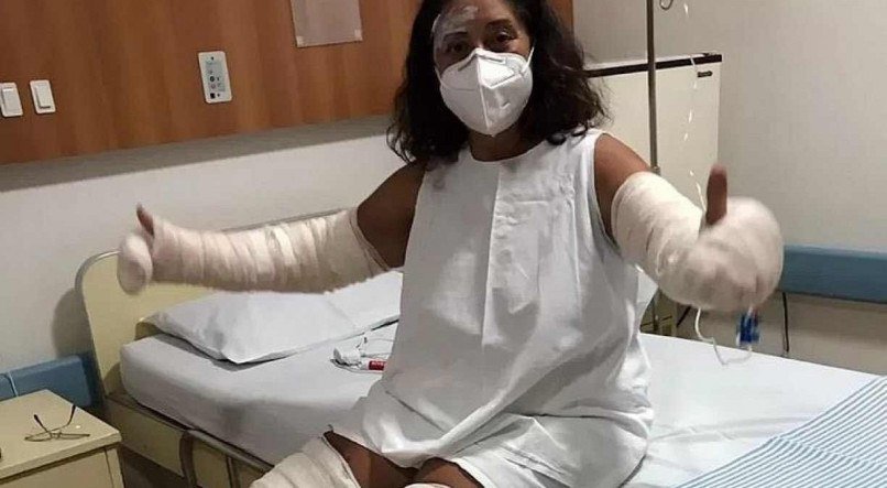 Mulher tem 40% do seu corpo queimado