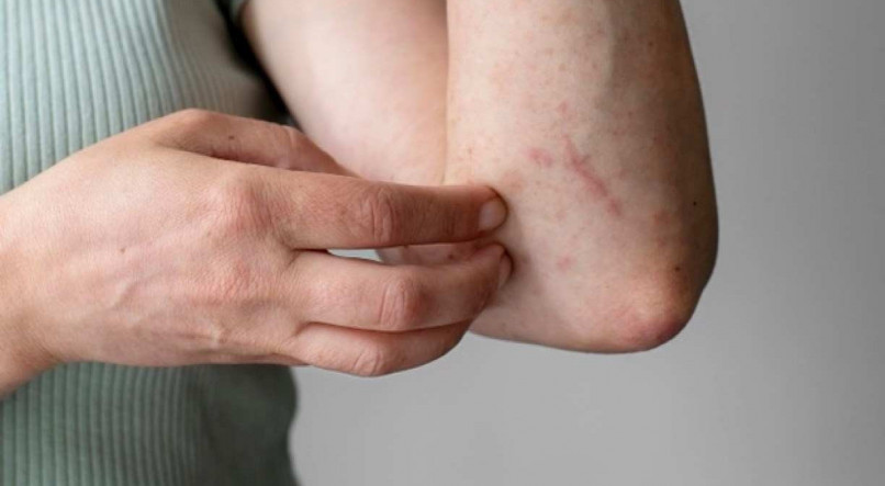 Os sinais e sintomas mais comuns s&atilde;o les&otilde;es na pele e coceira