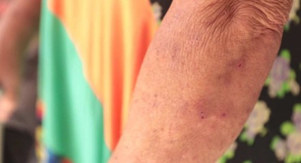 Surto de lesões que causam coceira na pele é investigado no Recife