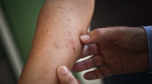 PELE IRRITADA Dermatite provoca coceira, irritação e formação de granulomas. Pode permanecer por dias e é tratada com uso de corticóides