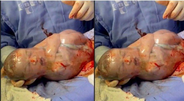 Bebê nasce empelicado e equipe médica filma momento em que a bolsa é rompida