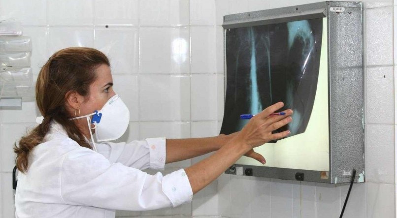 DIAGNÓSTICO Descoberta da tuberculose exige investigação clínico-epidemiológica e exames bacteriológicos