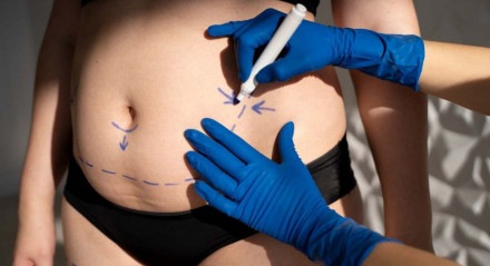 Muitas mãe realizam cirurgias plásticas após gravidez por não se sentirem a vontade com as mudanças em seus corpos