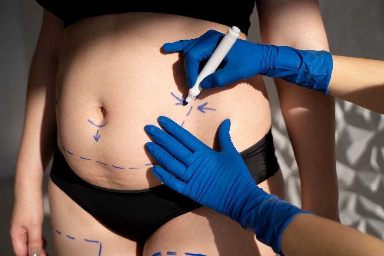 ESTÉTICA E GESTAÇÃO: cirurgias plásticas após gravidez são comuns, mas precisam de cuidados especiais; cirurgião plástico sobre segurança nos procedimentos