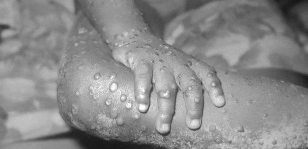 Erupções causadas pela varíola dos macacos no corpo de uma menina na Libéria

