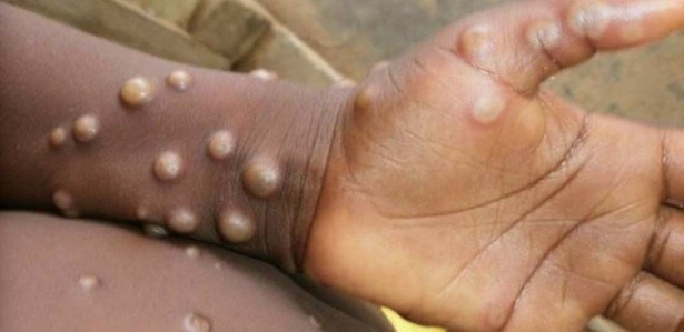 A varíola causa erupções na pele e é letal