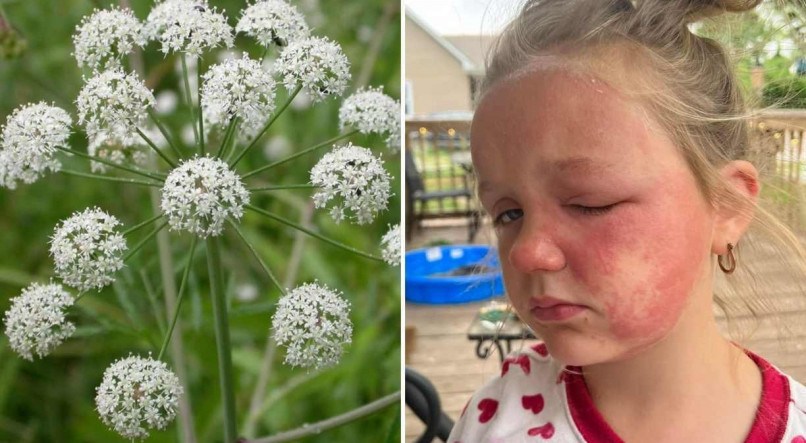 Uma menina de 6 anos quase morreu ap&oacute;s ter contato com a flor de uma das plantas mais perigosas da Am&eacute;rica: a CICUTA VENENOSA