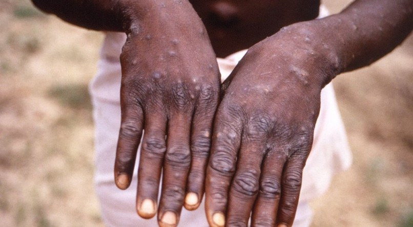 DOENÇA Varíola foi considerada um caso de emergência global pela OMS e está presente em 75 países