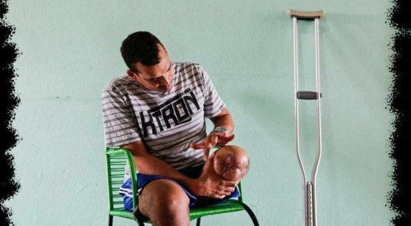 Confira a série de reportagens Mutilados - As verdadeiras vítimas do trânsito
