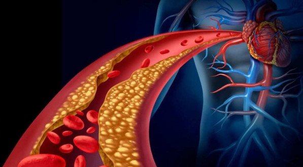 COLESTEROL ALTO SINTOMAS: COLESTEROL ALTO PODE MATAR? Veja o que o COLESTEROL ALTO pode causar no corpo; SINTOMAS DE COLESTEROL ALTO