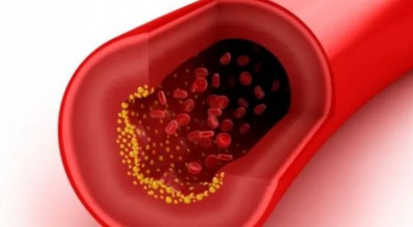 Veja o impacto do vinagre de ma&ccedil;a no tratamento do colesterol alto