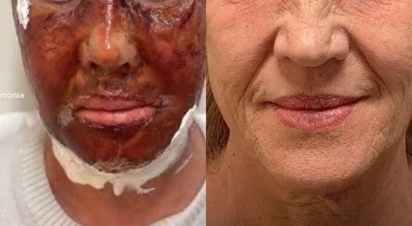 PEELING DE FENOL - REPRODUÇÃO/TIK TOK