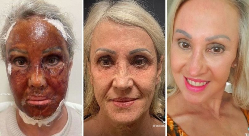 Imagem de partes do vídeo no TikTok que se tornou viral com os efeitos da aplicação do peeling