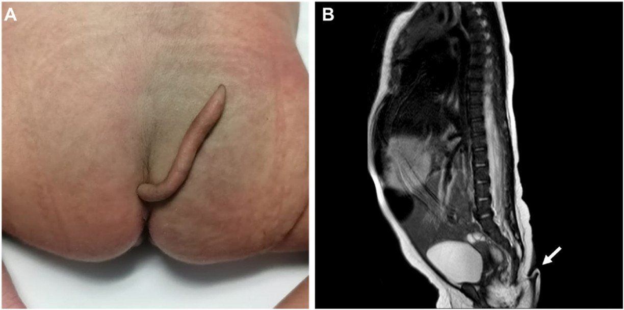 Divulgação / Journal of Pediatric Surgery Case Reports