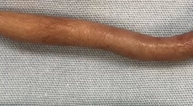 Bebê nasce com "cauda" de quase 6 centímetros; veja IMAGENS do caso extremamente raro