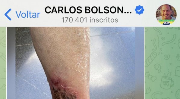 Carlos Bolsonaro publicou foto da perna do presidente Jair Bolsonaro com ferimento causado pela erisipela