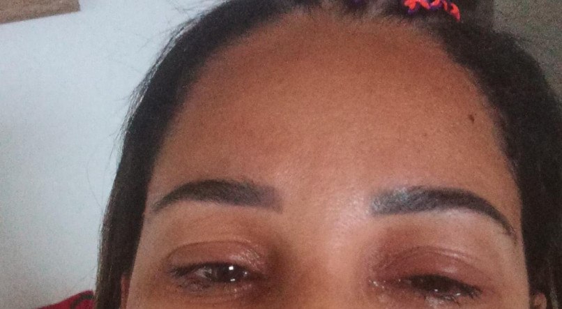 Olhos de Marcela inchados no dia seguinte ao uso da pomada para cabelo