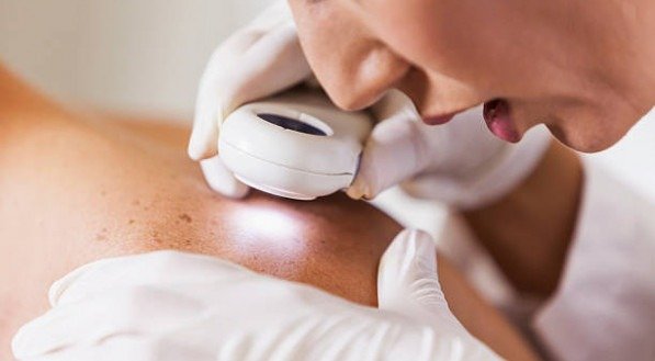 CÂNCER DE PELE COÇA? Veja SINTOMAS do CÂNDER DE PELE e saiba como IDENTIFICAR a DOENÇA