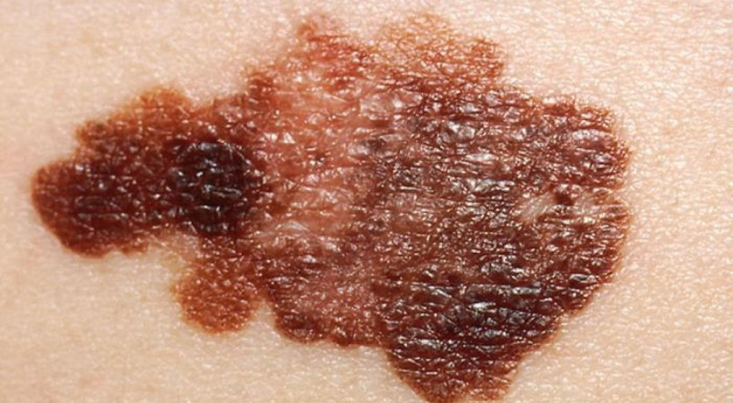 A modalidade de tratamento do câncer de pele varia conforme o tipo e a extensão da doença