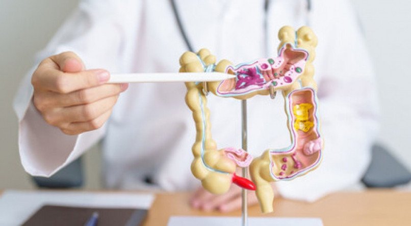 Car&ecirc;ncia de vitamina pode aumentar o risco de c&acirc;ncer de intestino; saiba qual