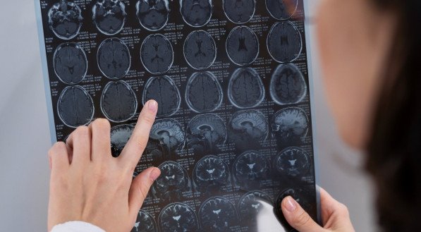 DIA MUNDIAL DO CÉREBRO: AVC mata cerca de 1,5 mil pessoas por ano em Pernambuco; neurologista orienta sobre prevenção