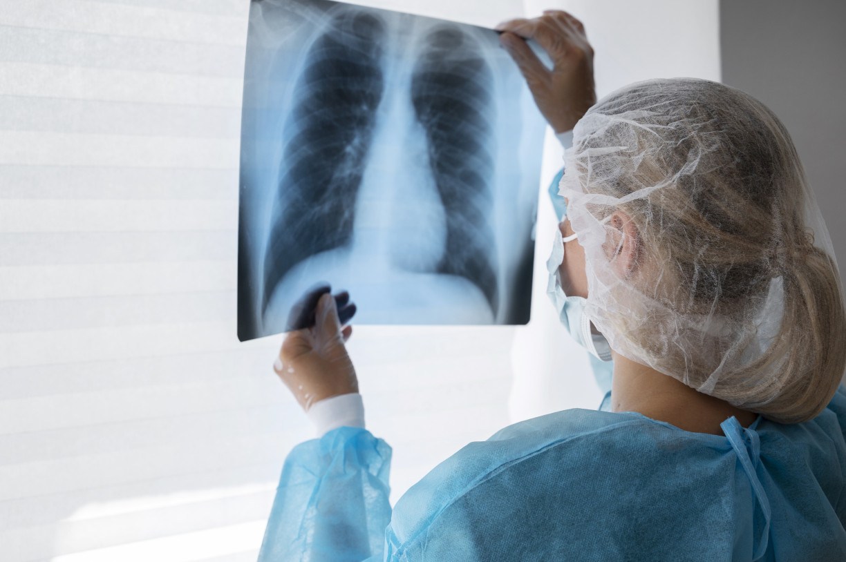 O câncer de pulmão ainda mata mais que o colorretal, mama e próstata no mundo