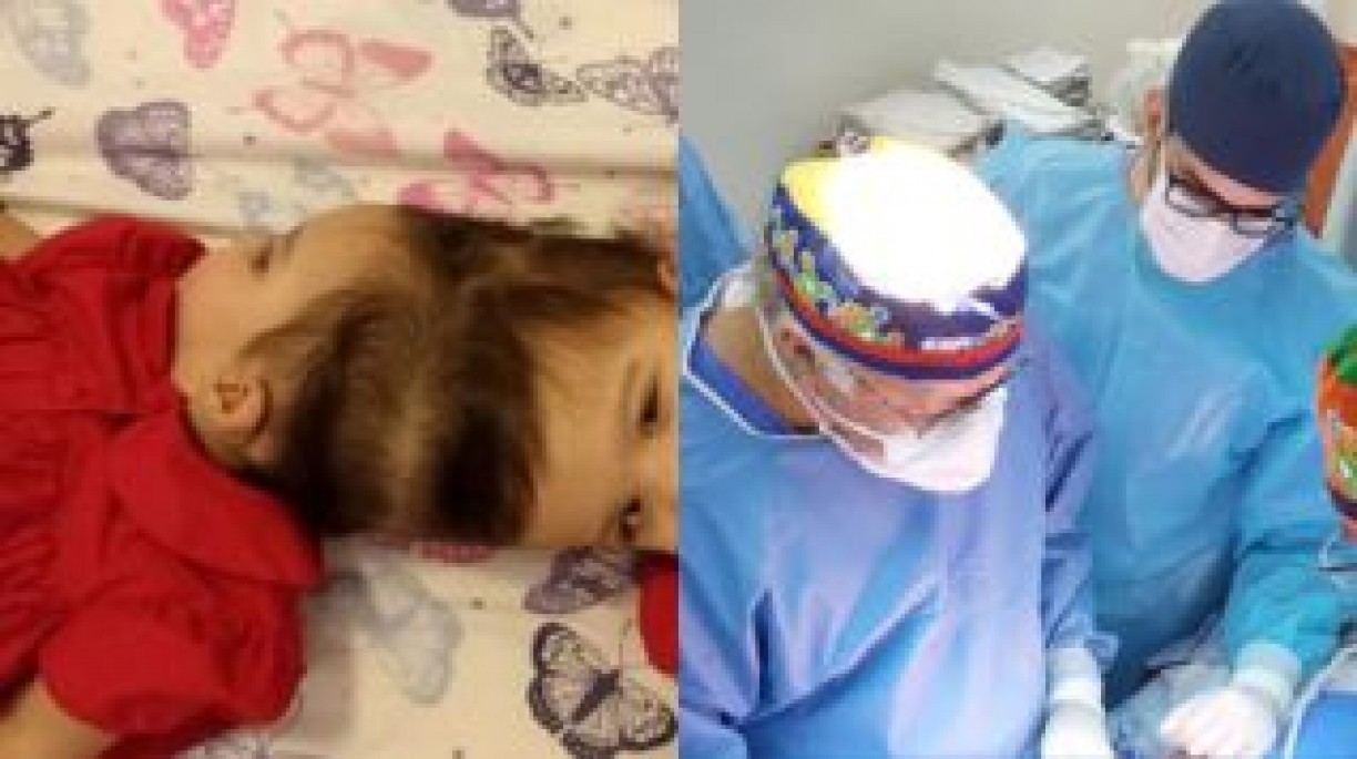 Gêmeas siameses passam por cirurgia de 25 horas para separação de crânio