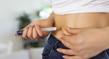 Especialistas apontam relação entre uso de canetas emagrecedoras e queda de cabelo