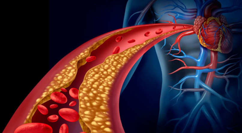Conhe&ccedil;a as principais causas do colesterol alto