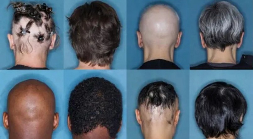 Veja o novo rem&eacute;dio para queda de cabelo aprovado pela Anvisa para combater a alopecia 