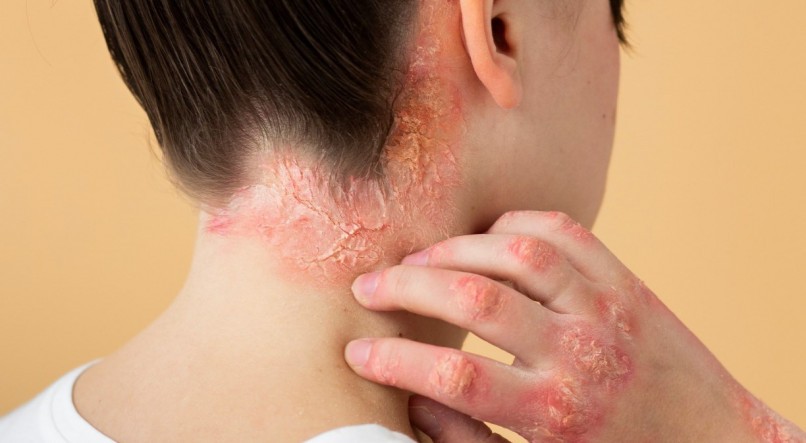 A psoríase pustulosa generalizada (PPG) é uma doença que afeta principalmente a pele, mas pode comprometer o paciente também de forma sistêmica. É rara, crônica, frequentemente imprevisível e potencialmente grave 