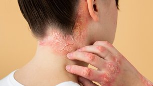 psoriase