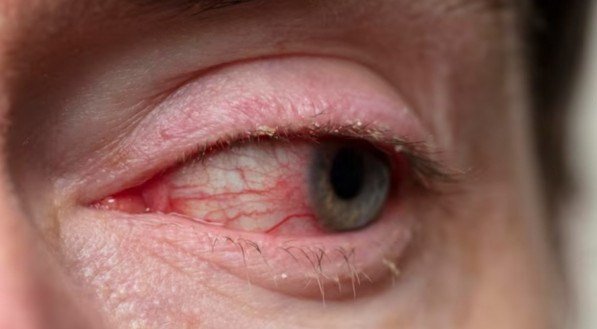 Sensação de areia nos olhos, secreção, lacrimejamento, vermelhidão e coceira são sintomas sugestivos de conjuntivite