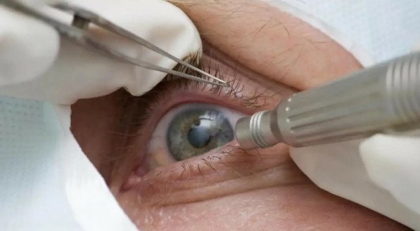 Médicos alertam para riscos de cirurgia de mudança da cor dos olhos