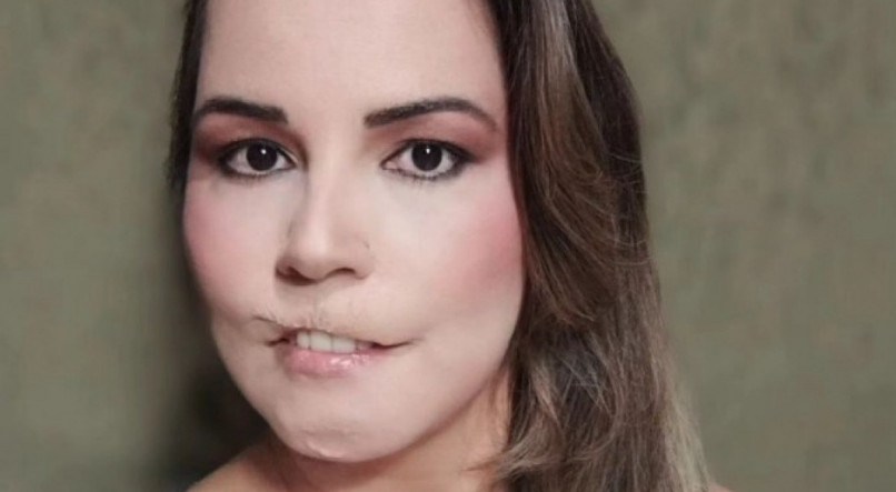Mariana Michelini perdeu o lábio após harmonização facial