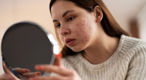 acne; pele oleosa; espinhas;