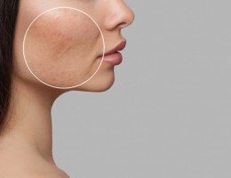 Acne: entenda sintomas, tratamento e cremes para cuidar da pele